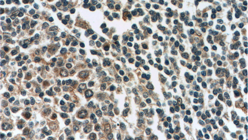 Immunohistochemistry of paraffin-embedded human tonsillitis tissue slide using Catalog No:116924(ZC3H12D Antibody) at dilution of 1:50 (under 40x lens)