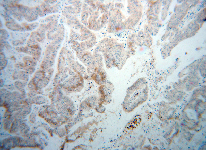 Immunohistochemical of paraffin-embedded human liver cancer using Catalog No:109755(DCP1B antibody) at dilution of 1:100 (under 10x lens)