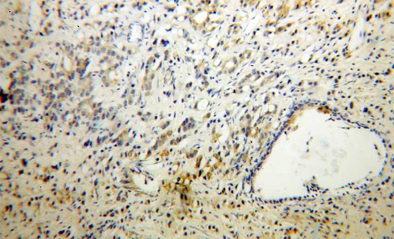Immunohistochemical of paraffin-embedded human prostate cancer using Catalog No:116972(WSB2 antibody) at dilution of 1:50 (under 10x lens)