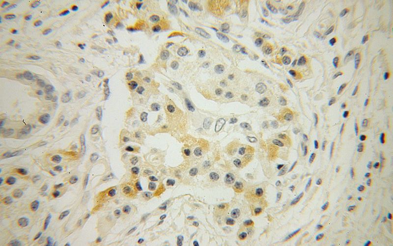Immunohistochemical of paraffin-embedded human pancreas cancer using Catalog No:114725(RNASET2 antibody) at dilution of 1:100 (under 40x lens)