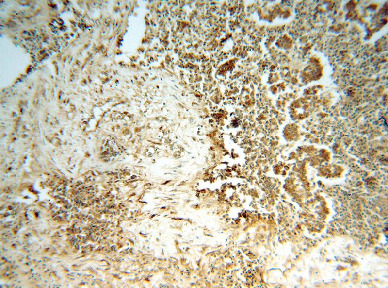 Immunohistochemical of paraffin-embedded human breast cancer using Catalog No:108247(ARF5 antibody) at dilution of 1:50 (under 10x lens)