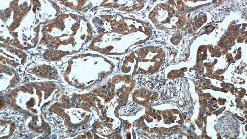 Immunohistochemical of paraffin-embedded human lung cancer using Catalog No:107985(ALKBH3 antibody) at dilution of 1:50 (under 10x lens)
