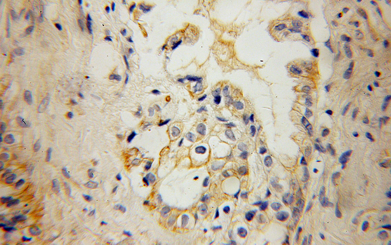 Immunohistochemical of paraffin-embedded human pancreas cancer using Catalog No:111930(KCNF1 antibody) at dilution of 1:100 (under 40x lens)