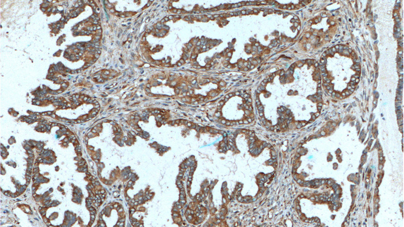 Immunohistochemistry of paraffin-embedded human ovary tumor tissue slide using Catalog No:112889(MUC16,CA125 Antibody) at dilution of 1:200 (under 10x lens). heat mediated antigen retrieved with Tris-EDTA buffer(pH9).