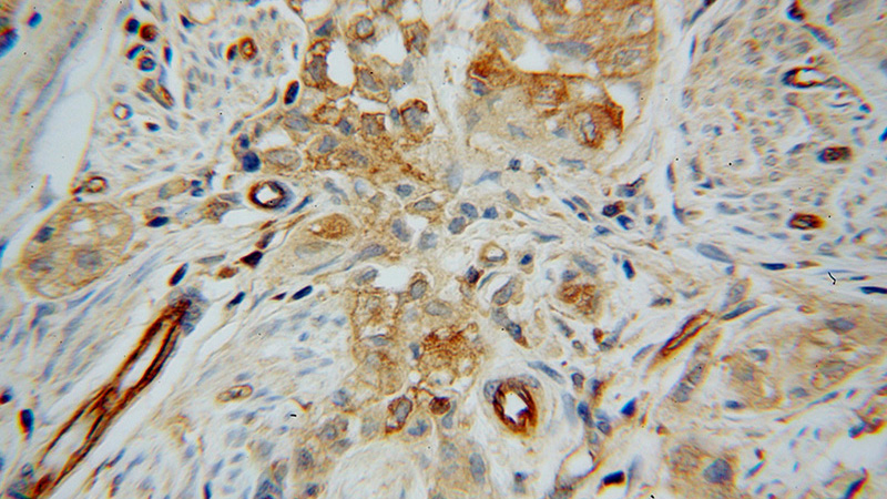 Immunohistochemical of paraffin-embedded human endometrial cancer using Catalog No:111463(HRH1 antibody) at dilution of 1:100 (under 40x lens)