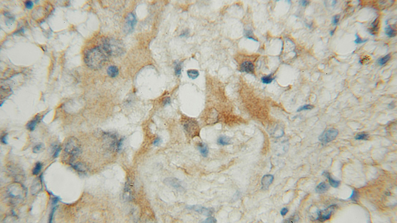 Immunohistochemical of paraffin-embedded human gliomas using Catalog No:111185(GSTM1 antibody) at dilution of 1:50 (under 10x lens)