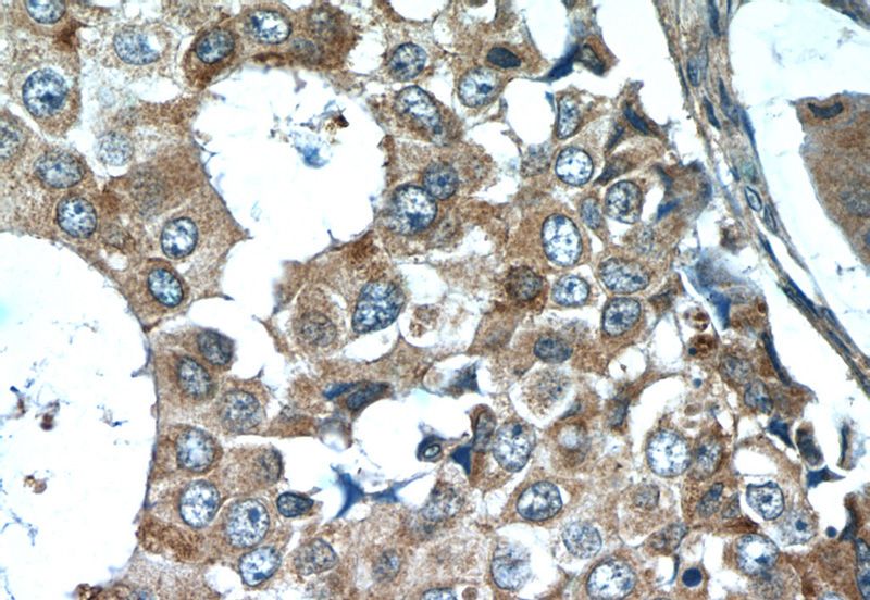 Immunohistochemistry of paraffin-embedded human breast cancer tissue slide using Catalog No:109599(CSN3 Antibody) at dilution of 1:25 (under 40x lens)