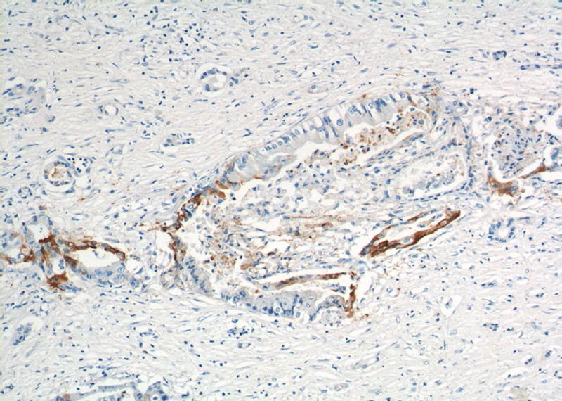 Immunohistochemistry of paraffin-embedded human pancreas cancer tissue slide using Catalog No:116988(XK Antibody) at dilution of 1:200 (under 10x lens).