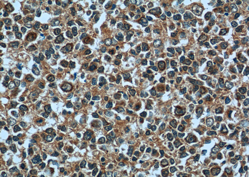 Immunohistochemistry of paraffin-embedded human tonsillitis tissue slide using Catalog No:113792(PGP Antibody) at dilution of 1:50 (under 40x lens)