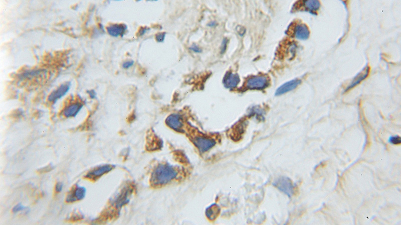 Immunohistochemical of paraffin-embedded human prostate cancer using Catalog No:111255(USH1C antibody) at dilution of 1:50 (under 10x lens)