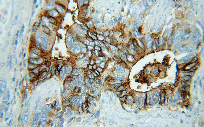Immunohistochemical of paraffin-embedded human stomach cancer using Catalog No:116011(TFF2 antibody) at dilution of 1:50 (under 40x lens)