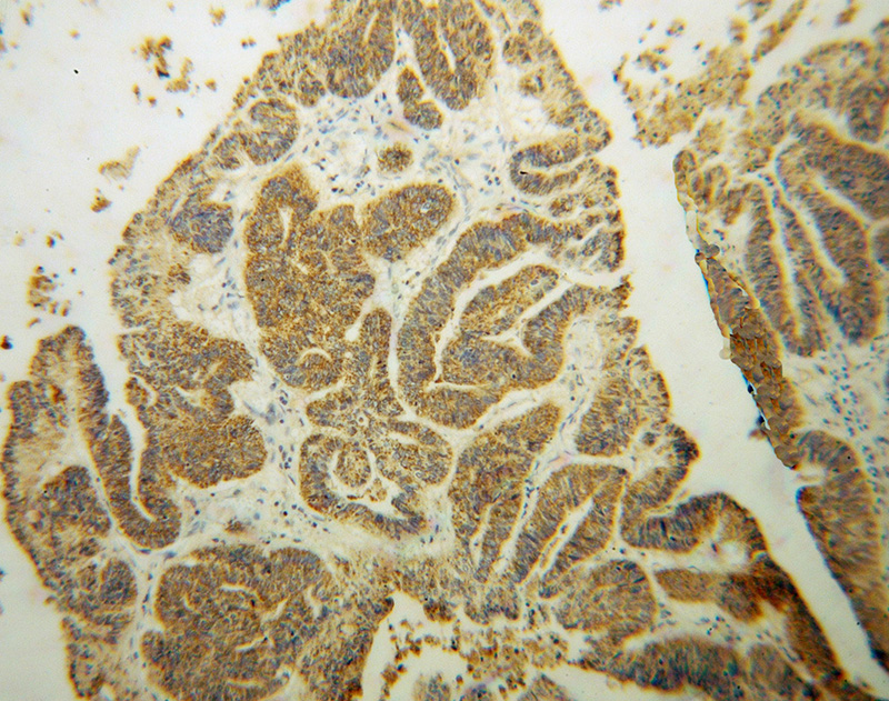 Immunohistochemical of paraffin-embedded human liver cancer using Catalog No:107808(ABCG4 antibody) at dilution of 1:50 (under 10x lens)