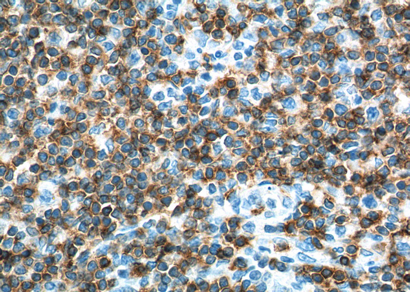 Immunohistochemistry of paraffin-embedded human tonsillitis tissue slide using Catalog No:109015(CD247 Antibody) at dilution of 1:200 (under 40x lens).