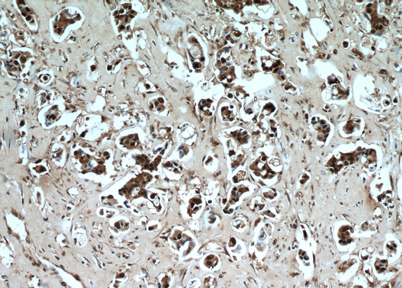 Immunohistochemical of paraffin-embedded human breast cancer using Catalog No:114385(PSMB5 antibody) at dilution of 1:50 (under 10x lens)