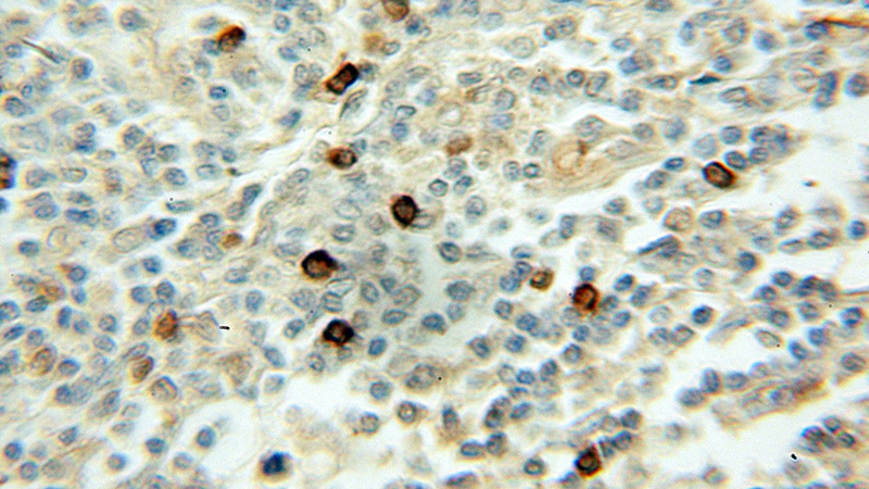 Immunohistochemical of paraffin-embedded human lymphoma using Catalog No:116515(UBE2A antibody) at dilution of 1:50 (under 10x lens)