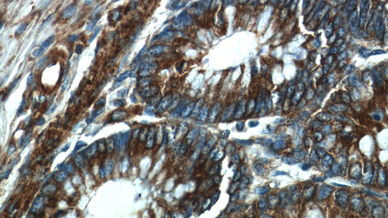 Immunohistochemistry of paraffin-embedded human colon tissue slide using Catalog No:114906(RPLP1 Antibody) at dilution of 1:50 (under 40x lens)