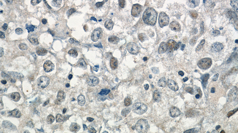 Immunohistochemistry of paraffin-embedded human breast cancer tissue slide using Catalog No:109835(DDX5,p68 Antibody) at dilution of 1:50 (under 40x lens)