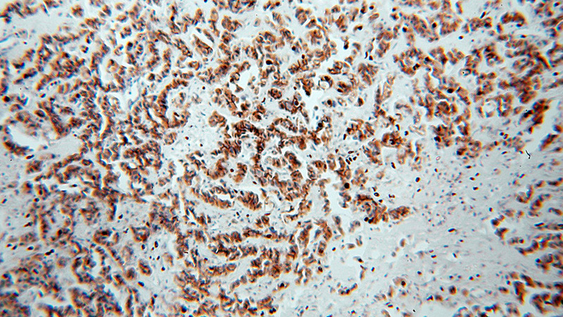 Immunohistochemical of paraffin-embedded human breast cancer using Catalog No:113619(CDH3 antibody) at dilution of 1:100 (under 10x lens)