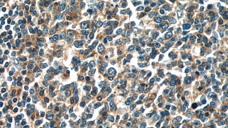 Immunohistochemistry of paraffin-embedded human tonsillitis tissue slide using Catalog No:107769(ADAMDEC1 Antibody) at dilution of 1:50 (under 40x lens)