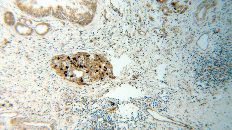 Immunohistochemical of paraffin-embedded human pancreas cancer using Catalog No:108942(CBS antibody) at dilution of 1:100 (under 10x lens)