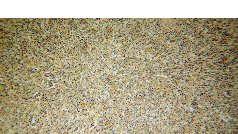 Immunohistochemical of paraffin-embedded human lymphoma using Catalog No:115310(SLC20A1 antibody) at dilution of 1:50 (under 10x lens)