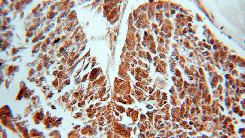 Immunohistochemical of paraffin-embedded human ovary tumor using Catalog No:110999(GNB5 antibody) at dilution of 1:100 (under 10x lens)