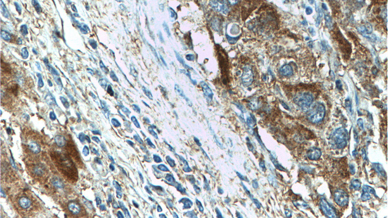 Immunohistochemistry of paraffin-embedded human liver cancer tissue slide using Catalog No:110602(FAM84B Antibody) at dilution of 1:200 (under 40x lens).