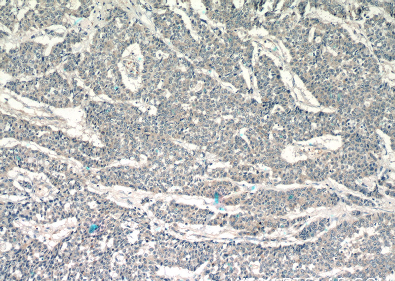 Immunohistochemistry of paraffin-embedded human colon cancer tissue slide using Catalog No:112308(LPO Antibody) at dilution of 1:50 (under 10x lens)