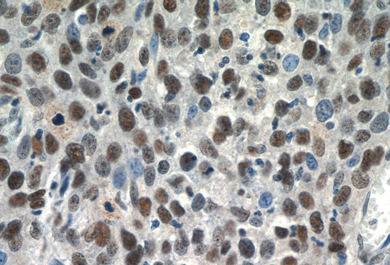Immunohistochemistry of paraffin-embedded human cervical cancer tissue slide using Catalog No:115458(SNRPB Antibody) at dilution of 1:50 (under 40x lens)