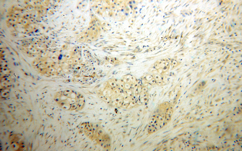 Immunohistochemical of paraffin-embedded human lung cancer using Catalog No:115025(SDCCAG1 antibody) at dilution of 1:50 (under 10x lens)