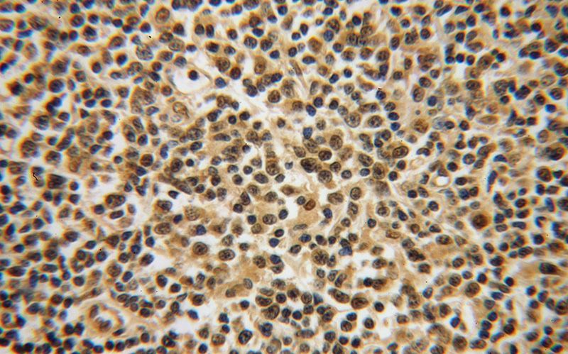 Immunohistochemical of paraffin-embedded human lymphoma using Catalog No:112287(PSMB8 antibody) at dilution of 1:50 (under 40x lens)