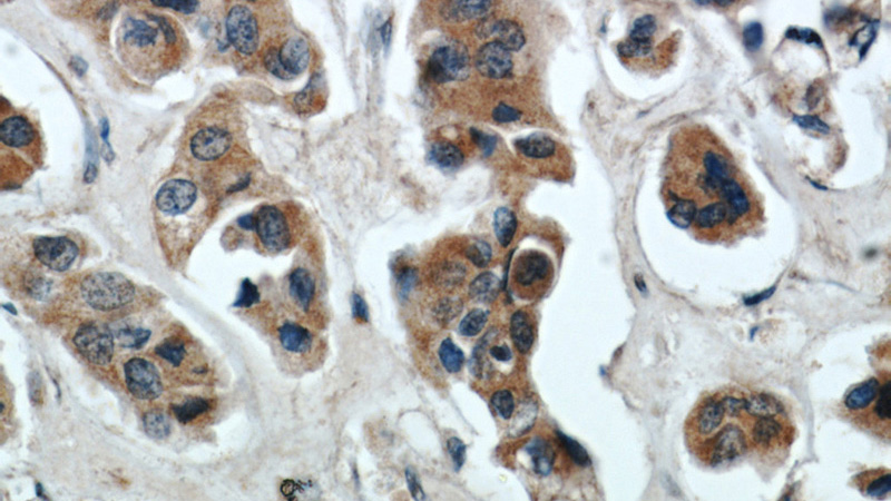 Immunohistochemical of paraffin-embedded human breast cancer using Catalog No:116384(TTC39A antibody) at dilution of 1:50 (under 40x lens)