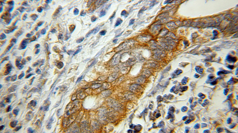 Immunohistochemical of paraffin-embedded human pancreas cancer using Catalog No:113568(PNLIP antibody) at dilution of 1:50 (under 40x lens)