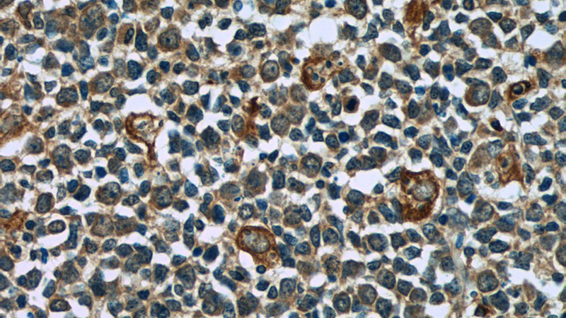 Immunohistochemistry of paraffin-embedded human tonsillitis tissue slide using Catalog No:109078(CCR7 Antibody) at dilution of 1:50 (under 40x lens)