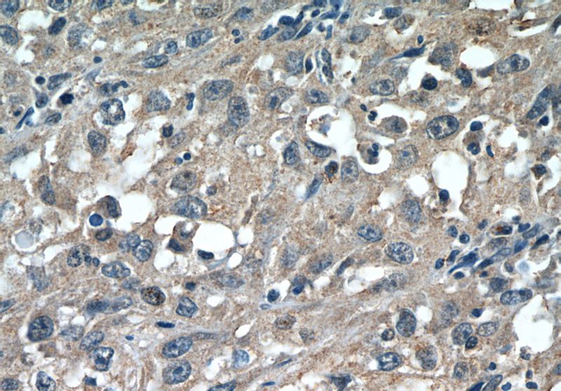 Immunohistochemistry of paraffin-embedded human cervical cancer tissue slide using Catalog No:109114(CDCA3 Antibody) at dilution of 1:50 (under 40x lens)