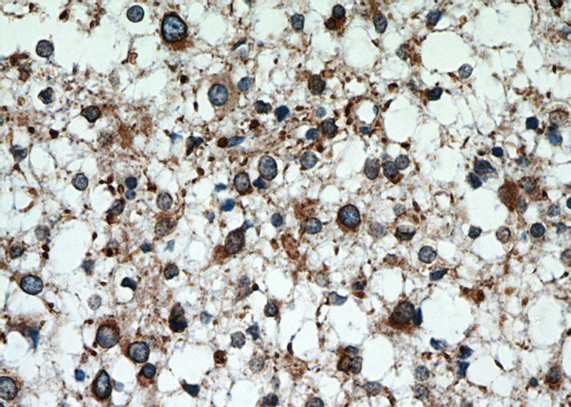 Immunohistochemical of paraffin-embedded human gliomas using Catalog No:112052(KIFAP3 antibody) at dilution of 1:50 (under 40x lens)
