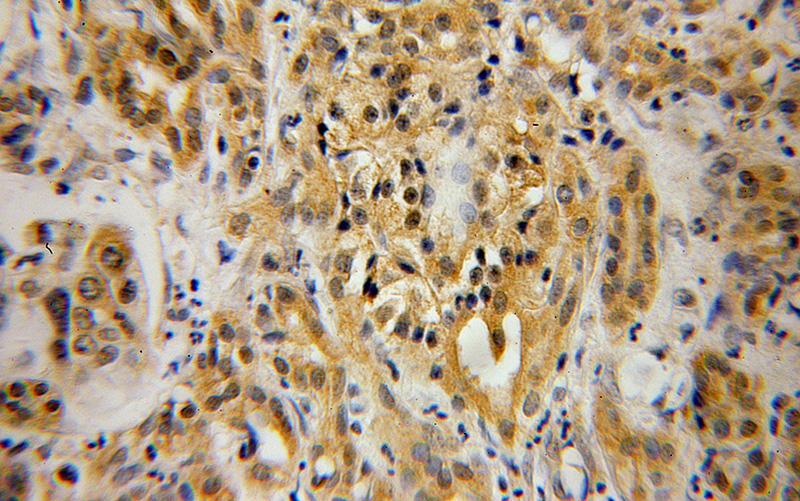 Immunohistochemical of paraffin-embedded human pancreas cancer using Catalog No:113913(PIP4K2B antibody) at dilution of 1:100 (under 40x lens)