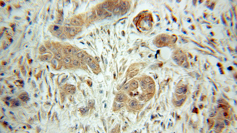 Immunohistochemical of paraffin-embedded human pancreas cancer using Catalog No:108259(ARHGAP1 antibody) at dilution of 1:50 (under 10x lens)