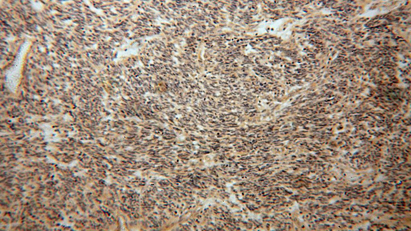 Immunohistochemical of paraffin-embedded human gliomas using Catalog No:115398(SMOX antibody) at dilution of 1:100 (under 10x lens)