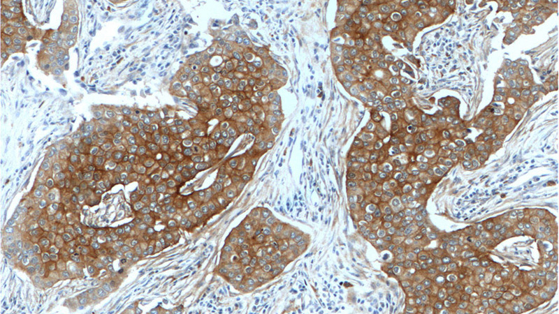 Immunohistochemistry of paraffin-embedded human breast cancer tissue slide using Catalog No:110245(ENAH Antibody) at dilution of 1:200 (under 10x lens).