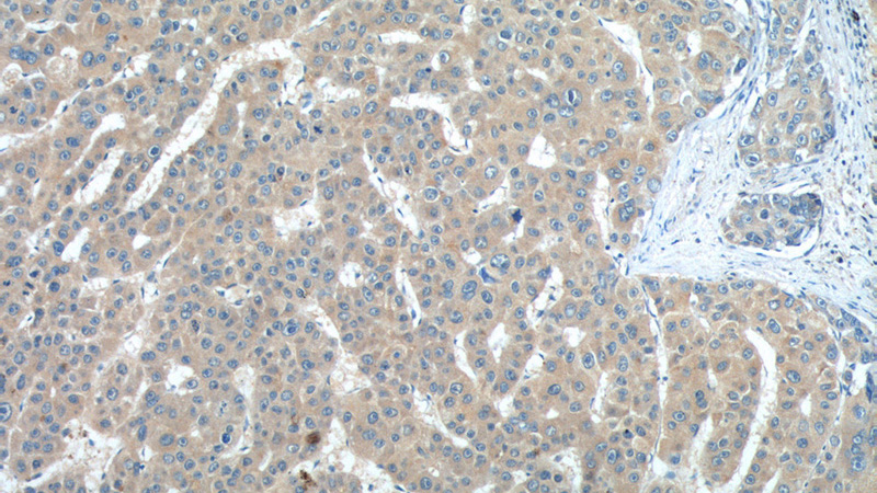 Immunohistochemistry of paraffin-embedded human liver cancer tissue slide using Catalog No:111781(IL27 Antibody) at dilution of 1:50 (under 10x lens)