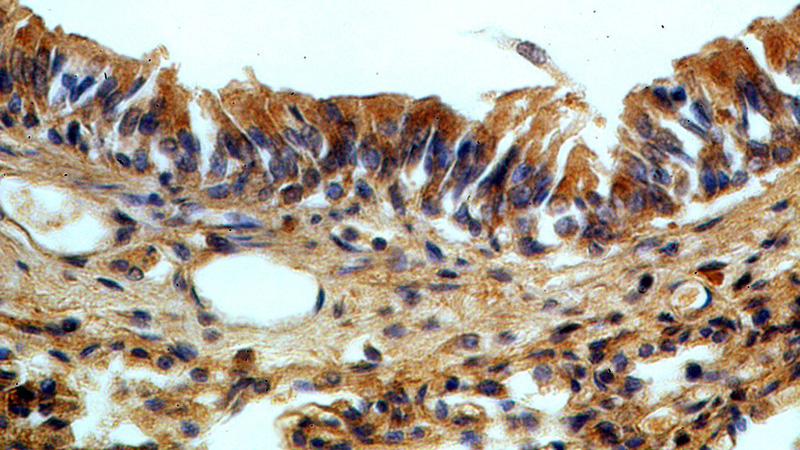 Immunohistochemical of paraffin-embedded human lung using Catalog No:117092(B3GNT5 antibody) at dilution of 1:50 (under 40x lens)