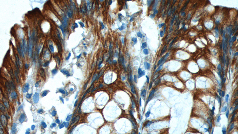 Immunohistochemistry of paraffin-embedded human colon tissue slide using Catalog No:109813(KRT8 Antibody) at dilution of 1:200 (under 40x lens).