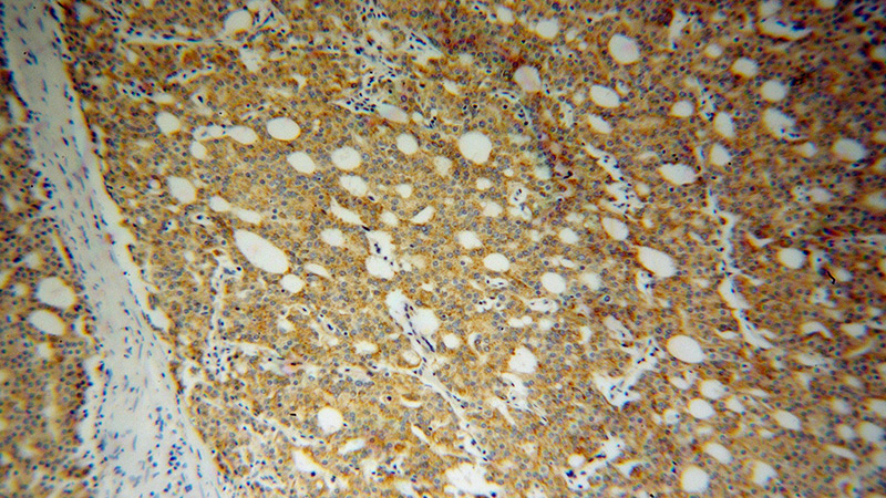 Immunohistochemical of paraffin-embedded human prostate cancer using Catalog No:114415(RAB18 antibody) at dilution of 1:100 (under 10x lens)