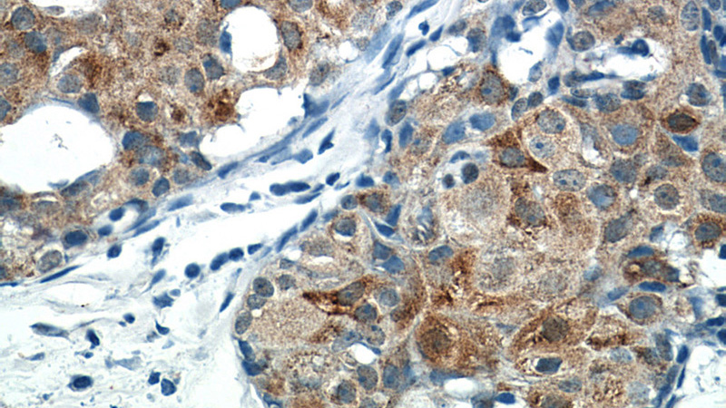 Immunohistochemistry of paraffin-embedded human breast cancer tissue slide using Catalog No:116057(THRSP Antibody) at dilution of 1:50 (under 40x lens)