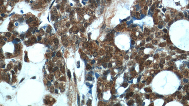 Immunohistochemical of paraffin-embedded human cervical cancer using Catalog No:107237(DDB1 antibody) at dilution of 1:50 (under 40x lens)