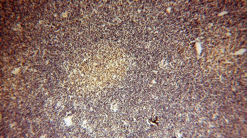 Immunohistochemical of paraffin-embedded human lymphoma using Catalog No:114781(ROD1 antibody) at dilution of 1:100 (under 10x lens)