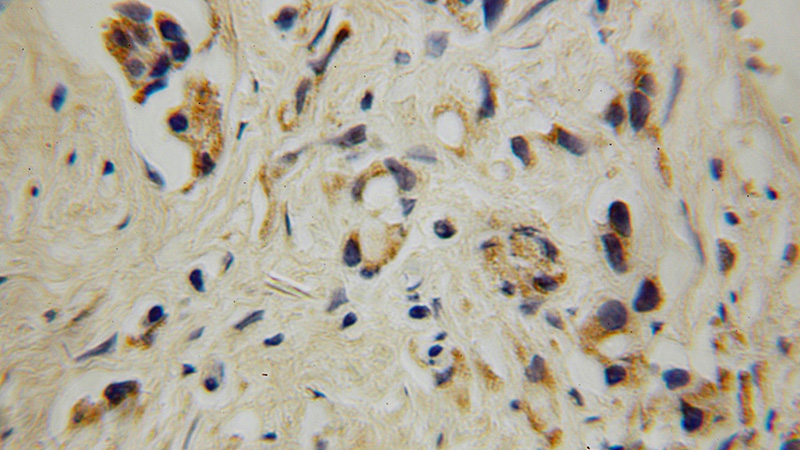 Immunohistochemical of paraffin-embedded human prostate cancer using Catalog No:110847(GALNT4 antibody) at dilution of 1:100 (under 10x lens)