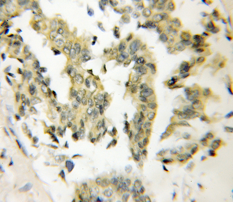 Immunohistochemical of paraffin-embedded human breast cancer using Catalog No:115408(SMYD3 antibody) at dilution of 1:50 (under 10x lens)
