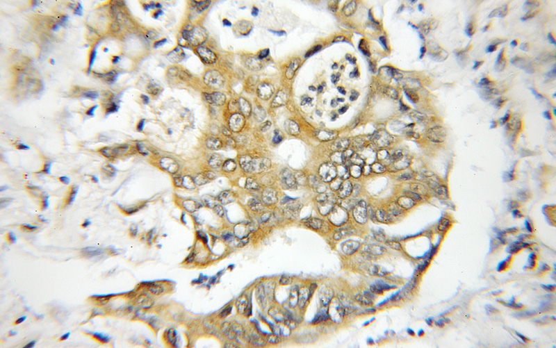 Immunohistochemical of paraffin-embedded human colon cancer using Catalog No:115091(EXoc4 antibody) at dilution of 1:50 (under 10x lens)